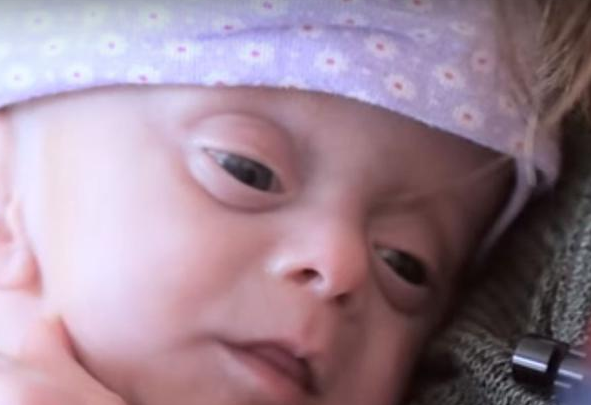 Berührende Geschichte: Das Baby ohne Gehirn